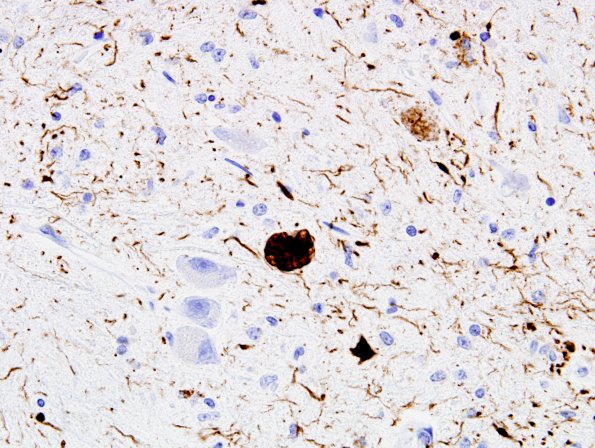 5C13 PSP (Case 5) ION PHF1 2