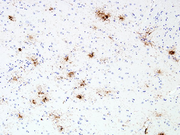 5C5 PSP (Case 5) Globus Pallidus PHF1 2