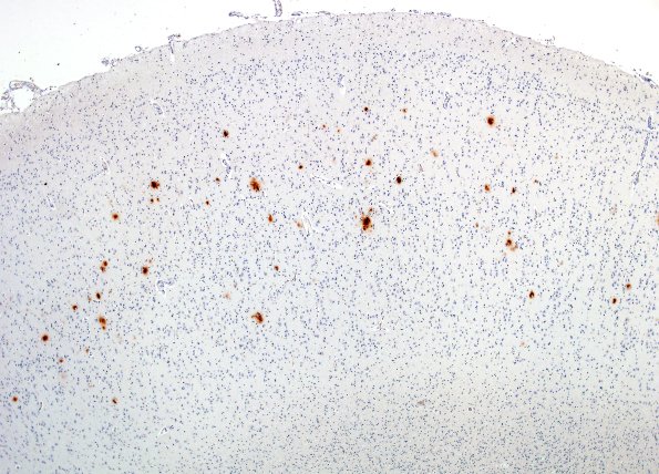 5D PSP (Case 5) Entorhinal (worst area) BAmyloid