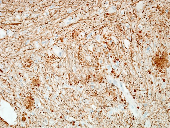 6H5 PSP (Case 6) N9 Dentate NF 4.jpg