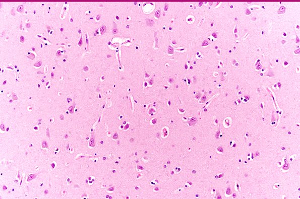 7B1 PSP (Case 7) L19 PHF 20XA