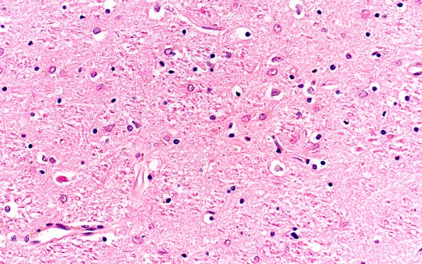 7B3 PSP (Case 7) L8 subthal H&E 40X