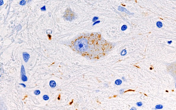 7C15 PSP (Case 7) L14 Dentate nucleus PHF 100X 3