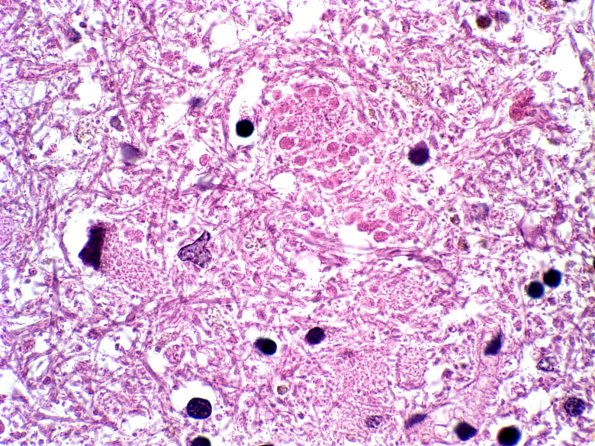 8B14 PSP (Case 8) Grumose Dentate b