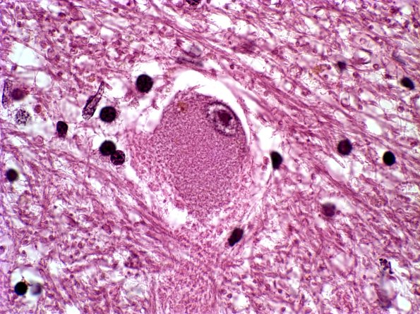 8B15 PSP (Case 8) Grumose Dentate c