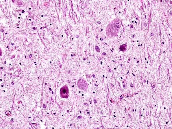 8B4 PSP (Case 8) Oculomotor nucleus H&E 23