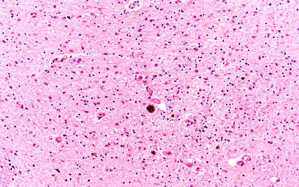 8B7 PSP (Case 8) N6 SN H&E 20X 1