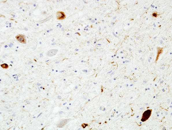 8C2 PSP (Case 8) Oculomotor nucleus PHF 27