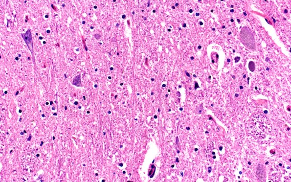 9B15 PSP (Case 9) L13 spinal cord H&E 40X 1