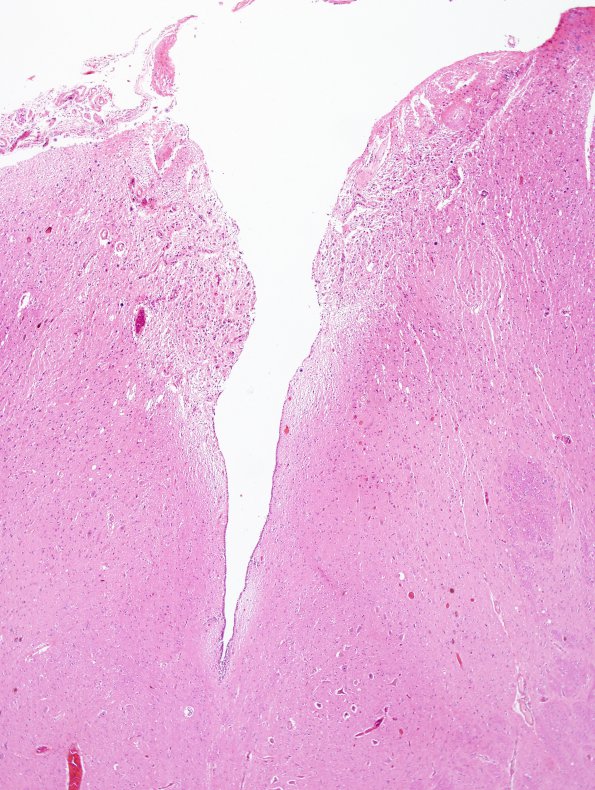 2A1 Area Postrema (Case 2) H&E 1