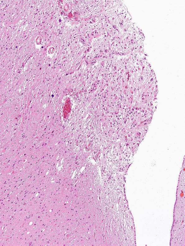 2A2 Area Postrema (Case 2) H&E 2