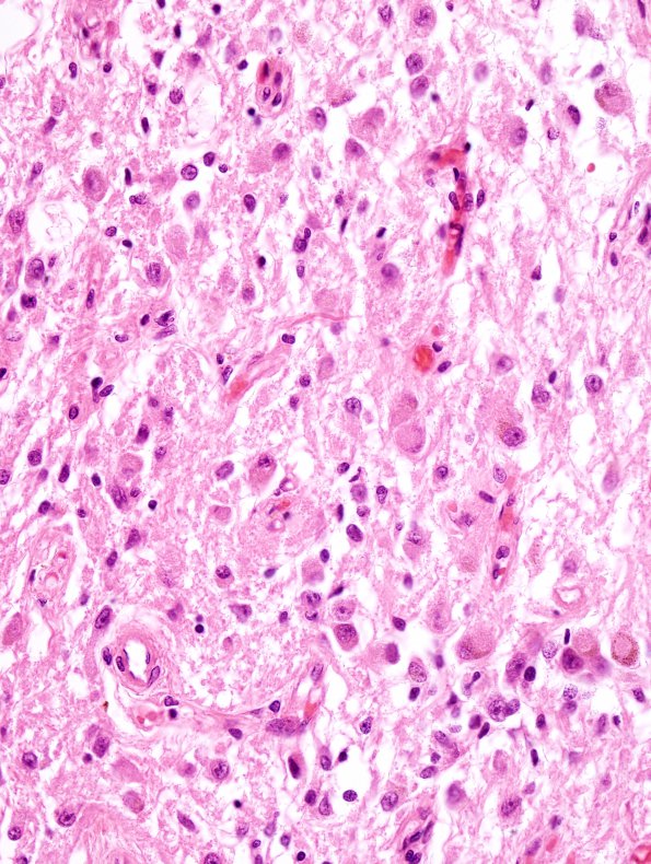 2A3 Area Postrema (Case 2) H&E 3