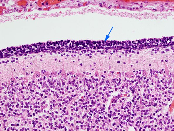 2A Cerebellum, 32 week gestation (Case 2) H&E 1 copy