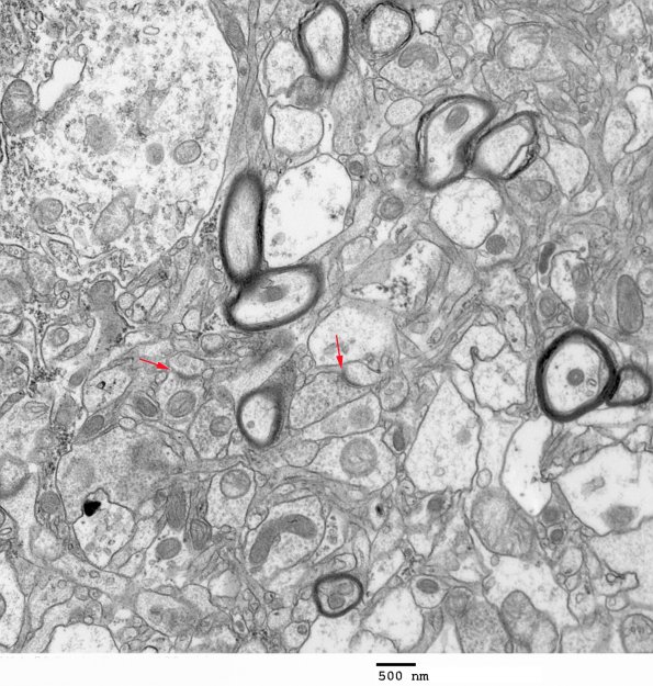 1A4 Normal Cerebral Cortex (Case 1) EM 130 - Copy