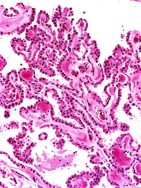 1 Choroid Plexus, Normal (Case 1)