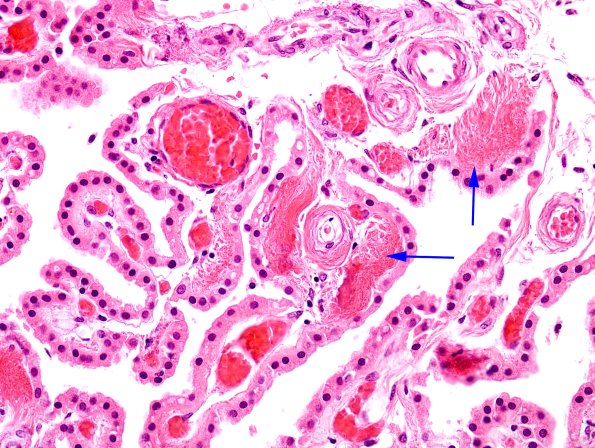 3A2 Choroid Plexus (Case 3) H&E 1 copy
