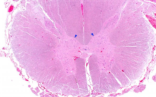 1A1 Clarke's Column Nucleus chromatolysis mimic (Case 1) H&E 6 copy