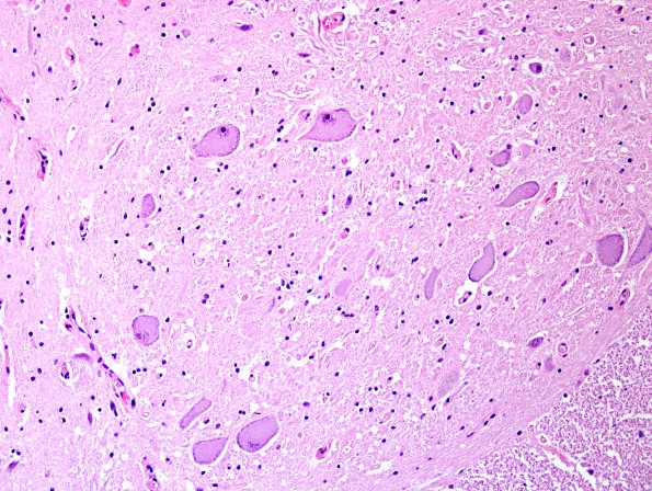 1A2 Clarke's Column Nucleus chromatolysis mimic (Case 1) H&E 2