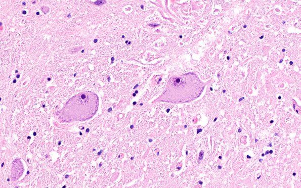 1A3 Clarke's Column Nucleus chromatolysis mimic (Case 1) H&E 40X