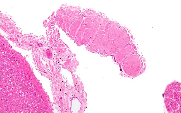 1A3 Denticulate ligament  (Case 1) H&E N10 10X