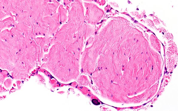 1A4 Denticulate ligament  (Case 1) H&E N10 40X