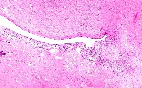 10A1 Ependyma, Lateral ventricle (Case 10) N2 4X
