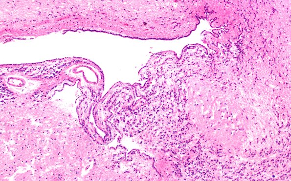 10A2 Ependyma, lateral ventricle (Case 10) N2 10X