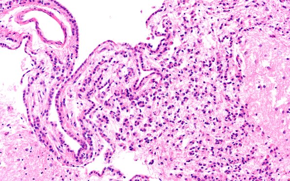 10A3 Ependyma, lateral ventricle (Case 10) N2 20X