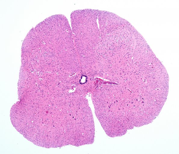 2 Spinal cord, neonatal (Case 2)