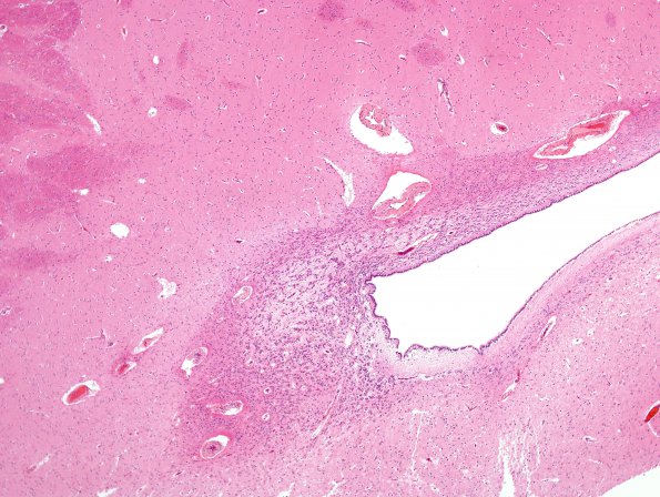 5A1 Ependyma, periventricular rests (Case 5) H&E 1