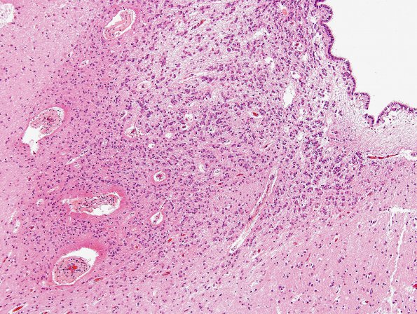 5A2 Ependyma, periventricular rests (Case 5) H&E 2