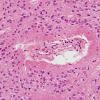 5A3 Ependyma, periventricular rests (Case 5) H&E 5