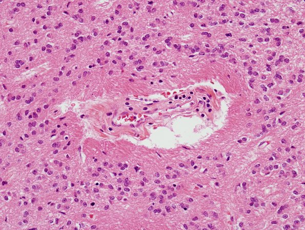 5A3 Ependyma, periventricular rests (Case 5) H&E 5