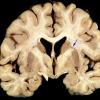 1 Basal ganglia (Case 1) 2 copy