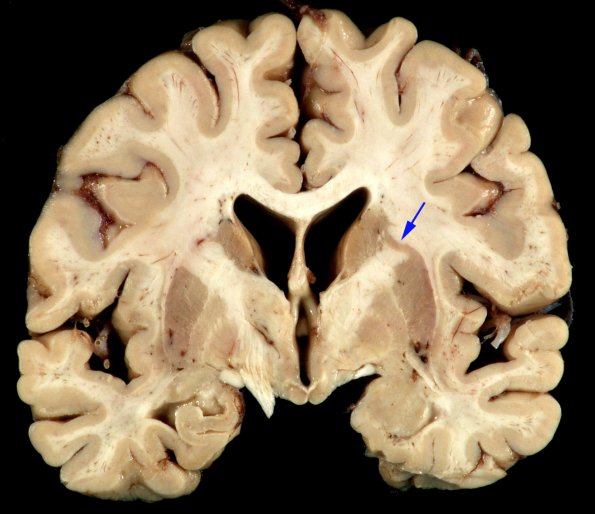 1 Basal ganglia (Case 1) 2 copy