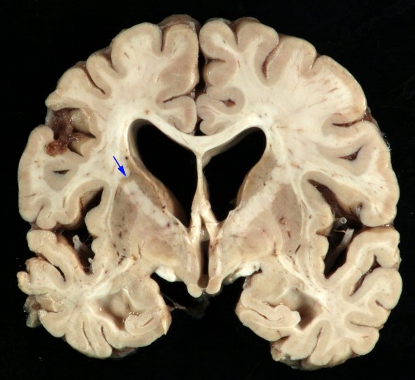 2 Basal Ganglia (Case 2) copy