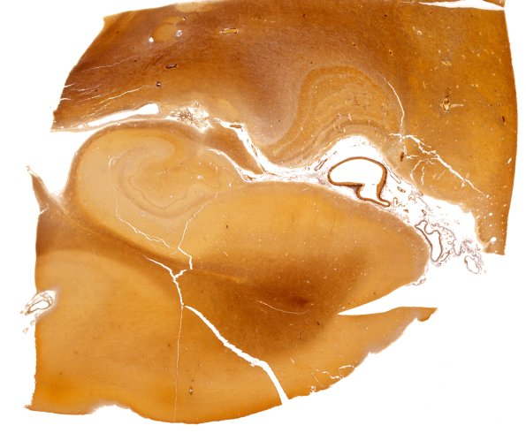 1A3 Hippocampus, normal (Case 1) Biels whole mount