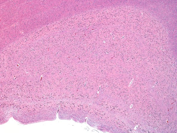 3B1 LGN (Case 3) H&E 1