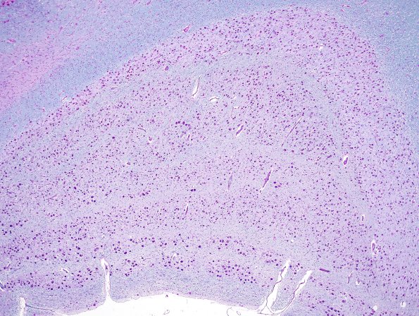 3B2 LGN (Case 3) LFB-PAS 1