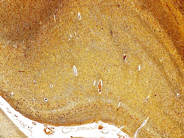 3B4 LGN (Case 3) Biels 4X