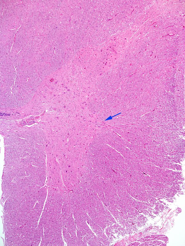 1A3 IML (Case 1) H&E 8 copy A