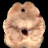 1A Interpeduncular Cistern (Case 1) copy