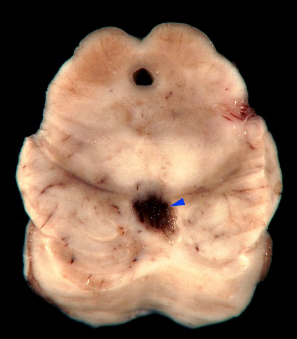 1A Interpeduncular Cistern (Case 1) copy