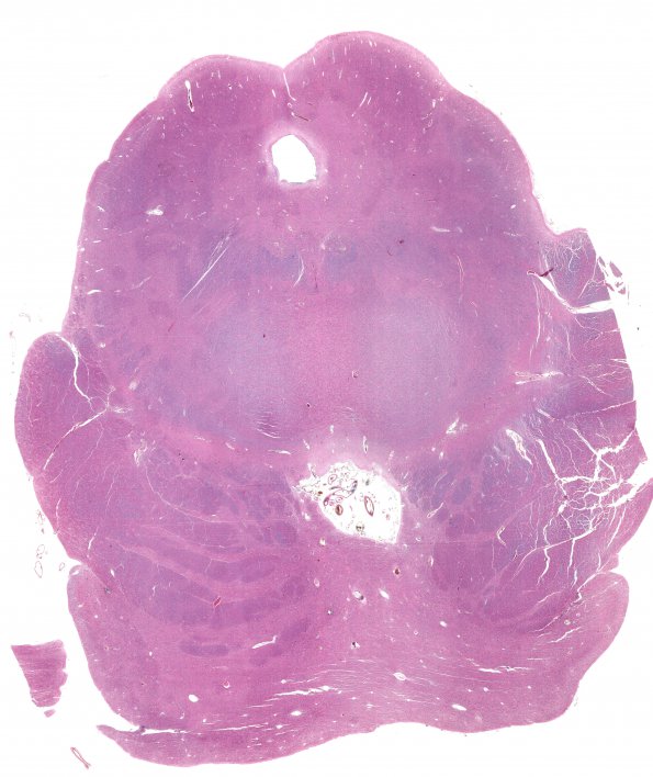 1B1 Interpeduncular Cistern (Case 1)