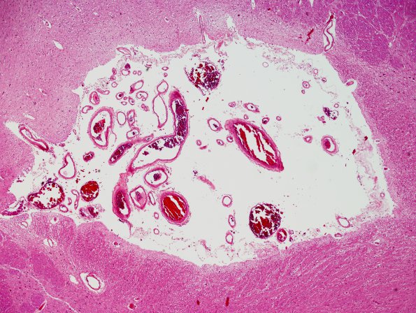 1B2 Interpeduncular Cistern (Case 1) N13 H&E 4X