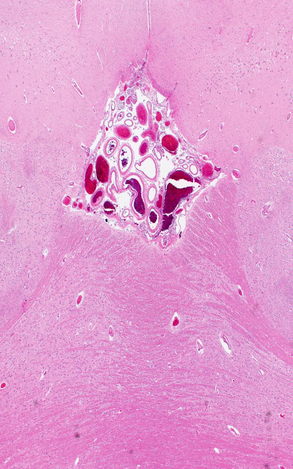 2B2 Interpeduncular fossa-recess (Case 2) N11 H&E 2X