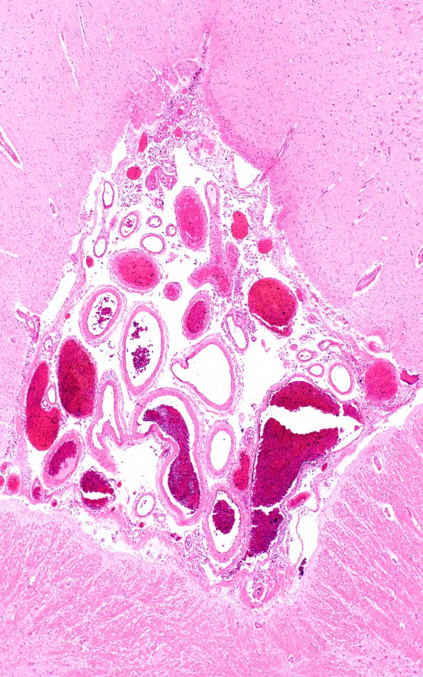 2B3 Interpeduncular fossa-recess (Case 2) N11 H&E 4X