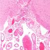 2B4 Interpeduncular fossa-recess (Case 2) N11 H&E 10X