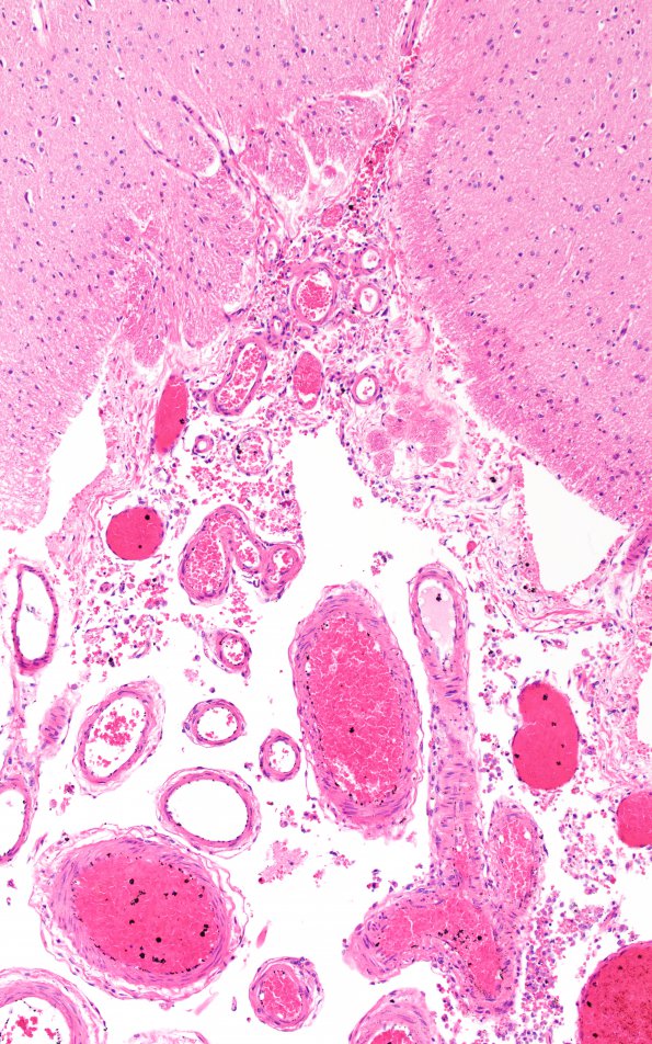 2B4 Interpeduncular fossa-recess (Case 2) N11 H&E 10X