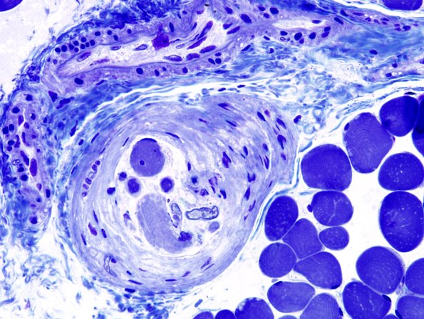 2A1 Muscle Spindle (Case 7) Plastic 1